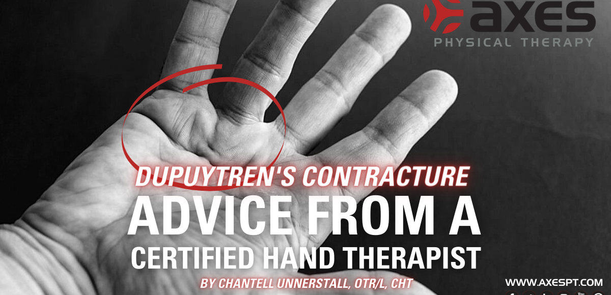 dupuytren’s contracture HAND THERAPY