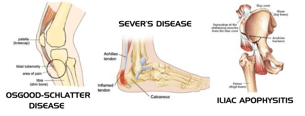 Overuse Injuries in Youth Sports: Apophysitis - Axes PT Blog