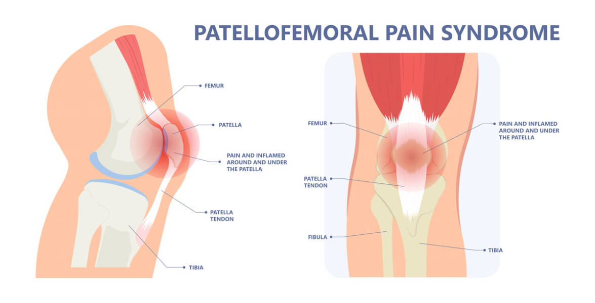 Runner’s Knee Pain Treatment | Physical Therapy for Patellofemoral Pain Syndrome